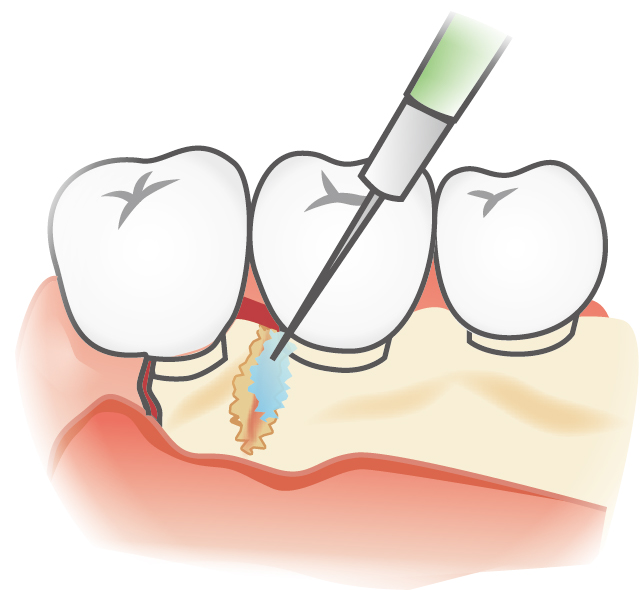 歯槽骨の再生治療