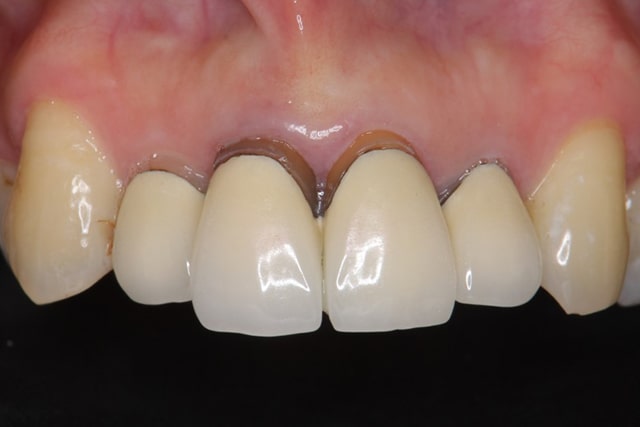 歯と歯茎の間の黒ずみ