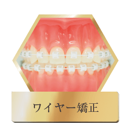 ワイヤー矯正