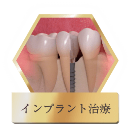インプラント治療