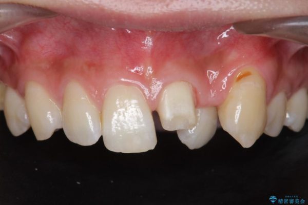 欠けた前歯のセラミック治療 治療中画像