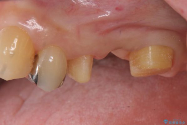 大きな穴があいた奥歯のブリッジ治療 治療中画像