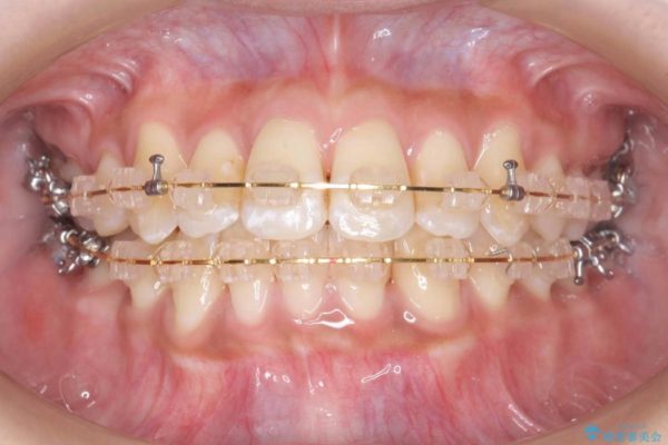 天然歯を活かす、スレ違い咬合矯正 治療中画像