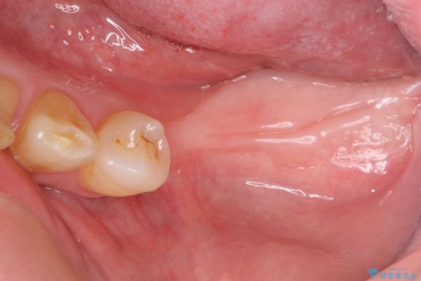 奥歯で噛みたいインプラント治療 治療中画像