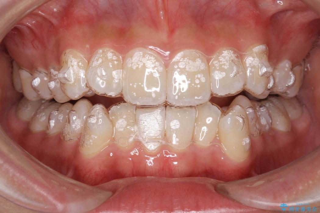 前歯の叢生のインビザライン矯正 治療中画像