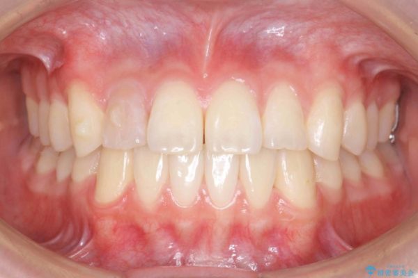 インビザラインで再矯正治療と右上前歯のセラミック治療 治療中画像