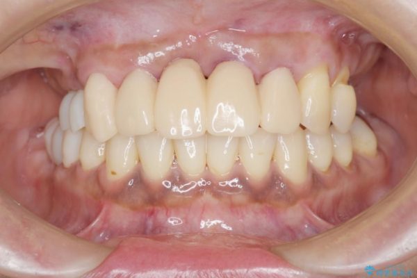 インプラントを用いた重度歯周病治療 治療中画像