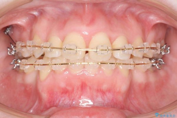 前歯のねじれと出っ歯の矯正 治療中画像