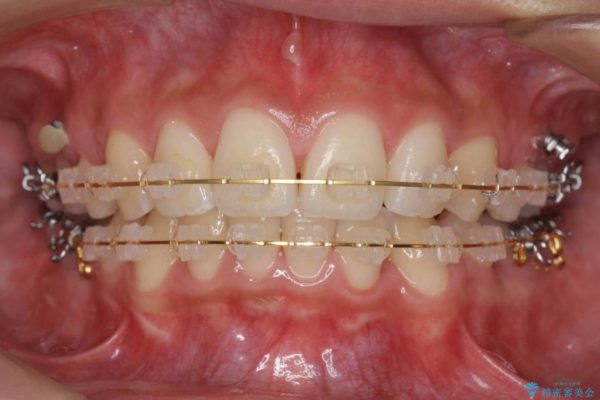 他院で治療した出っ歯の再矯正 治療中画像