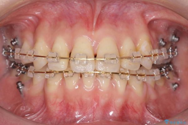 反対咬合（奥歯）のワイヤー矯正治療 治療中画像