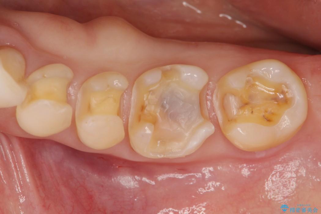 銀歯を白くするセラミックインレー 治療中画像