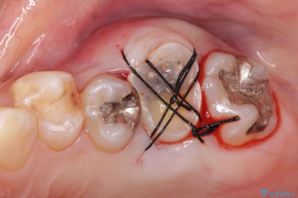 奥歯の親知らず移植 治療中画像