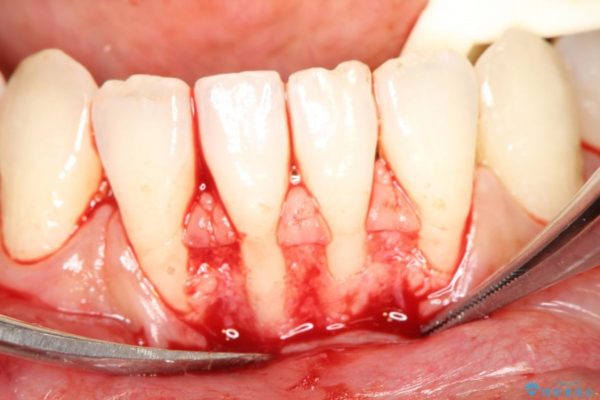 歯ぐきの再生治療 治療中画像