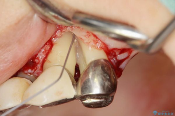 重度歯周病治療(歯槽骨の再生治療) 治療中画像