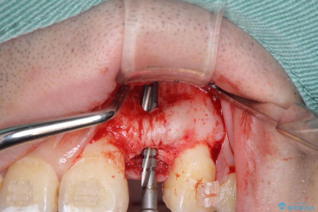 左上前歯のインプラント治療（インプラント埋入まで） 治療中画像