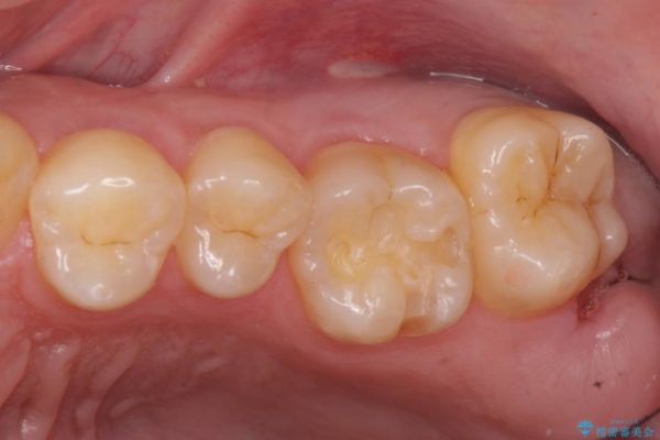 上の奥歯のゴールドインレー 治療中画像