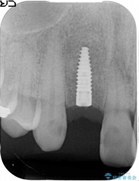 前歯のインプラント治療(インプラント埋入まで) 治療中画像
