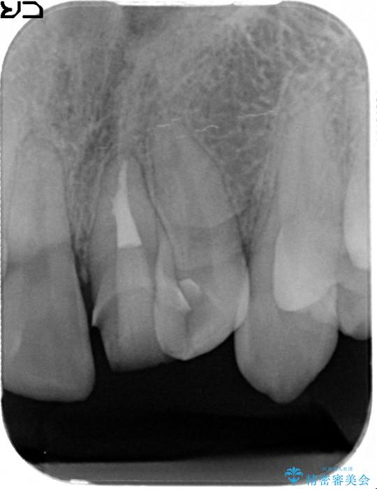 欠けた前歯のセラミック治療 治療中画像
