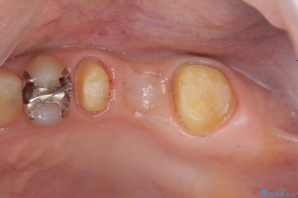大きな穴があいた奥歯のブリッジ治療 治療中画像
