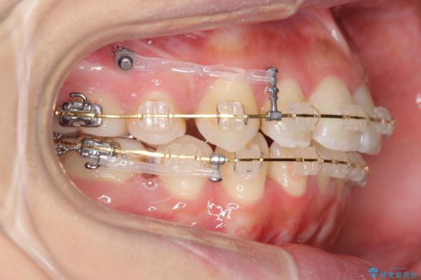 出っ歯(オーバージェット10mm)のワイヤー矯正 治療中画像