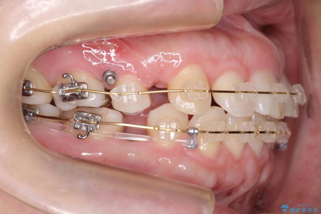 30代女性 出っ歯の再矯正治療 治療中画像