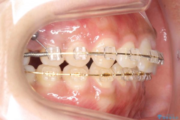 20代女性 すきっ歯の矯正歯科治療 治療中画像