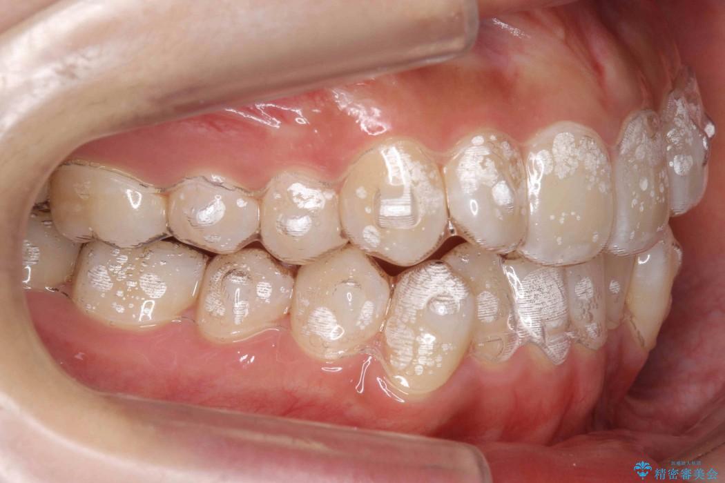 前歯の叢生のインビザライン矯正 治療中画像