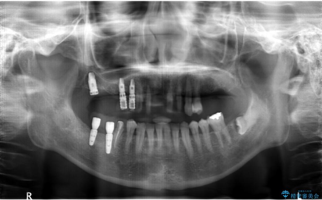 インプラントを用いた重度歯周病治療 治療中画像