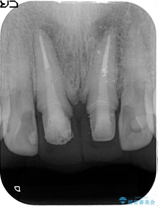 感染根管治療を伴った前歯のセラミック治療 治療中画像
