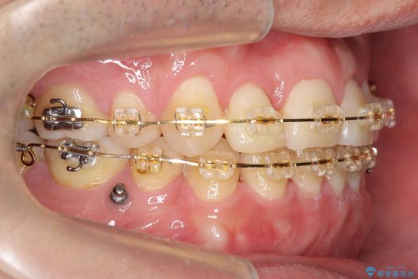 前歯のガタガタと奥歯の噛み合わせの矯正 治療中画像