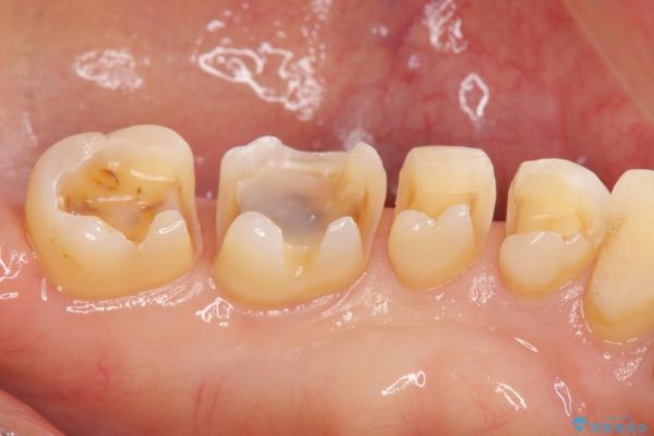 銀歯を白くするセラミックインレー 治療中画像