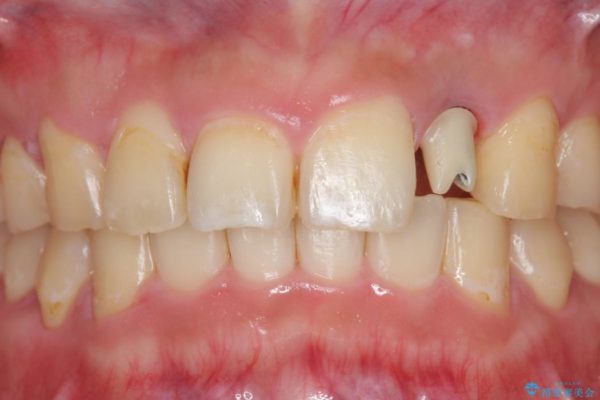 上の前歯のインプラント治療 治療中画像