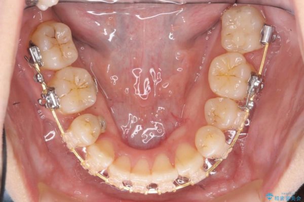 天然歯を活かす、スレ違い咬合矯正 治療中画像