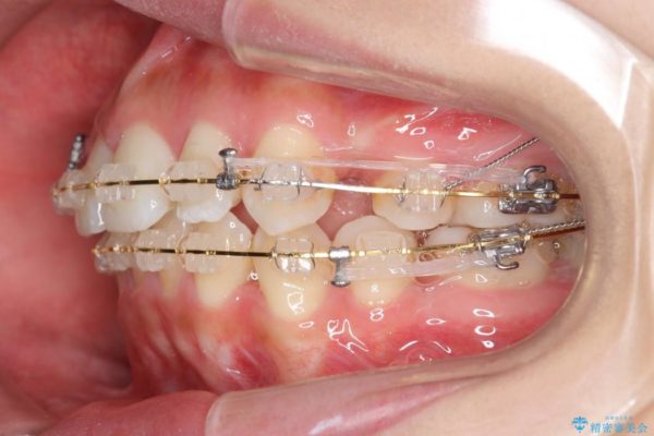 出っ歯(オーバージェット10mm)のワイヤー矯正 治療中画像
