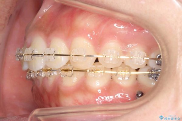 20代女性 すきっ歯の矯正歯科治療 治療中画像