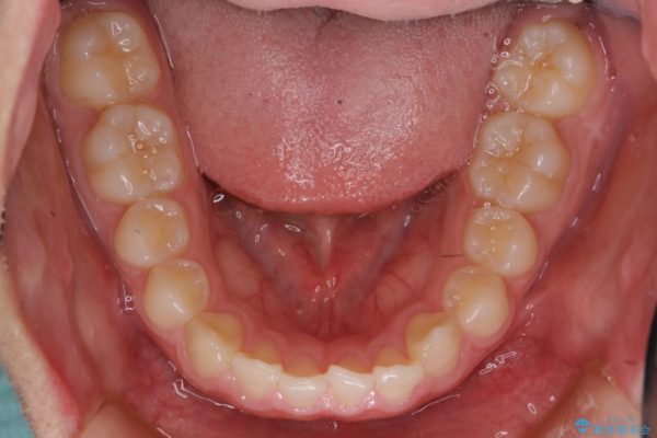 前歯のすき間と過蓋咬合のワイヤー矯正 治療中画像
