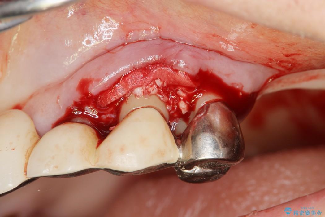 重度歯周病治療(歯槽骨の再生治療) 治療中画像