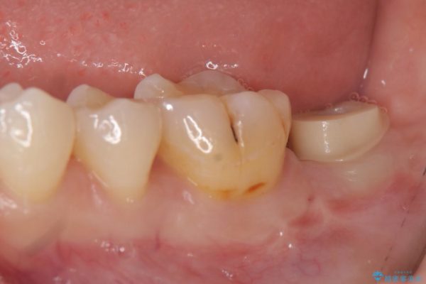 奥歯のストローマン・インプラント 治療中画像