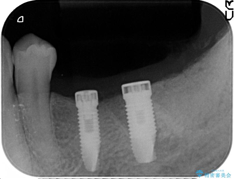 奥歯で噛みたいインプラント治療 治療中画像