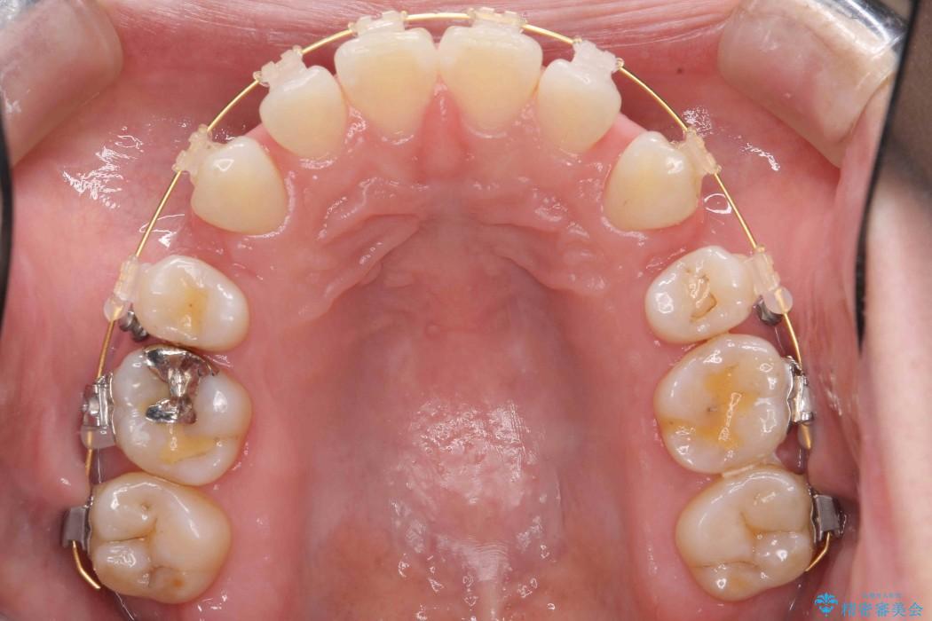 30代女性 出っ歯の再矯正治療 治療中画像