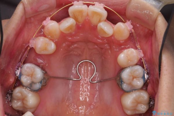 根の短い歯を抜歯 がたがたの歯並び矯正 治療中画像