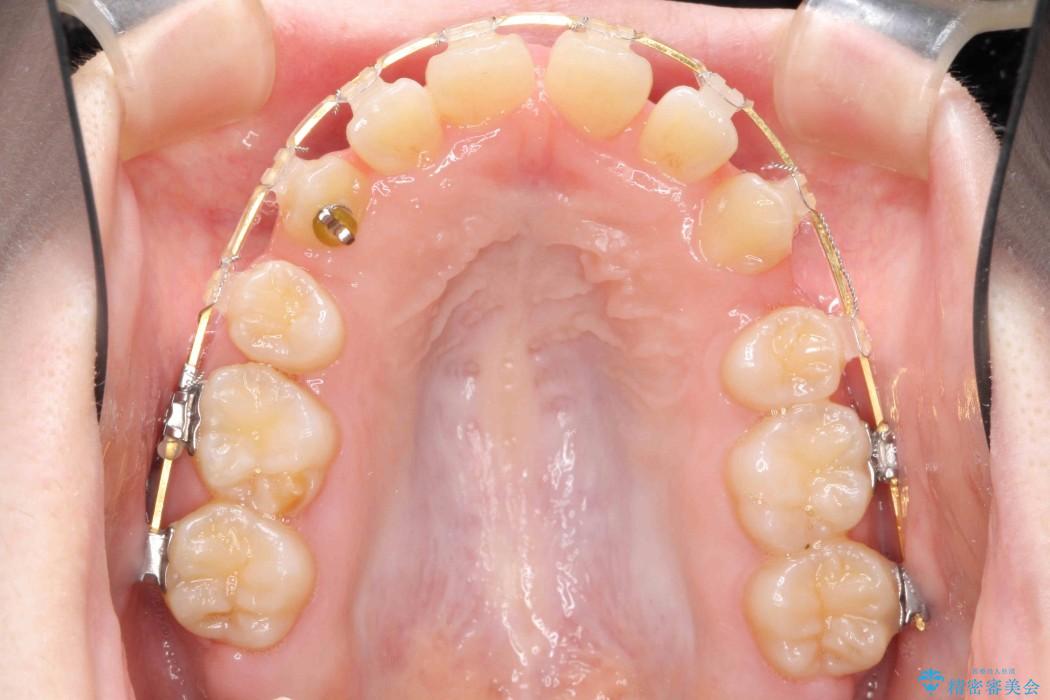 前歯のねじれと出っ歯の矯正 治療中画像