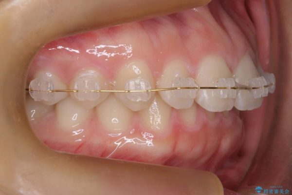 前歯のすき間と過蓋咬合のワイヤー矯正 治療中画像