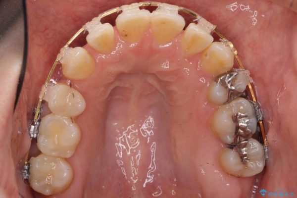 反対咬合（奥歯）のワイヤー矯正治療 治療中画像