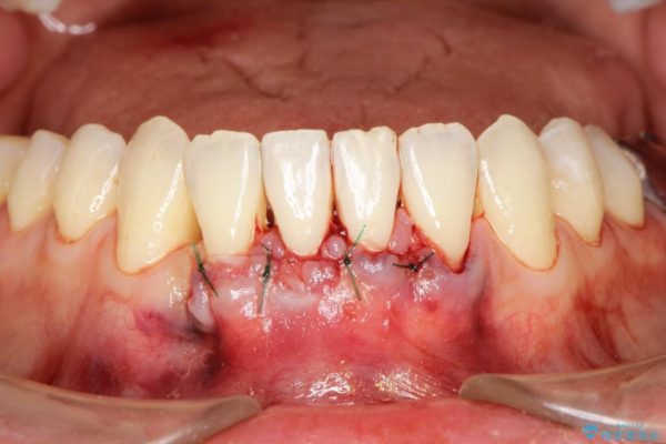 【歯肉退縮】歯ぐきの再生治療（歯茎の移植） 治療中画像