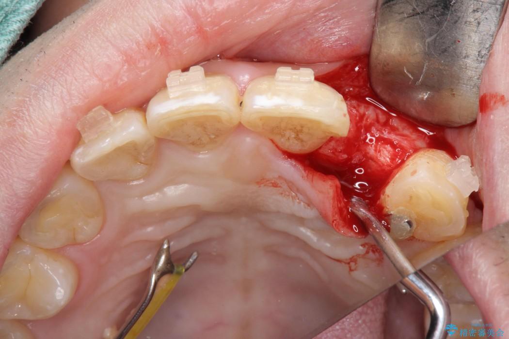 左上前歯のインプラント治療（インプラント埋入まで） 治療中画像