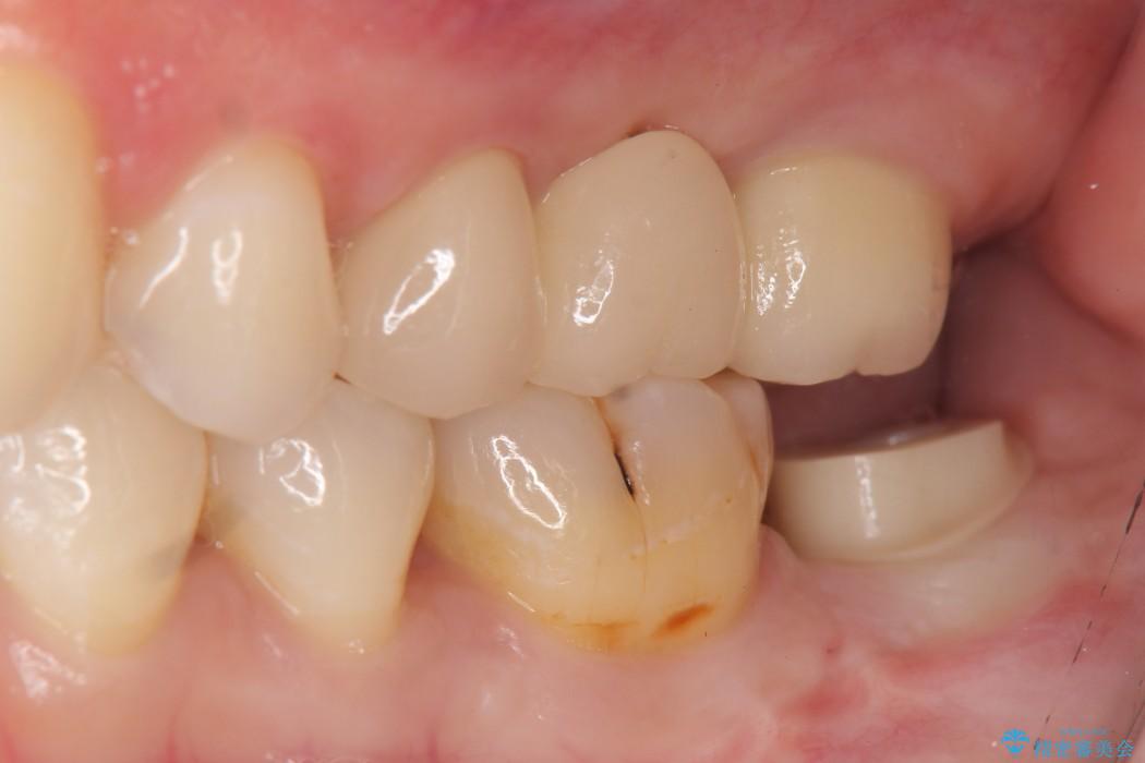 奥歯のストローマン・インプラント 治療中画像