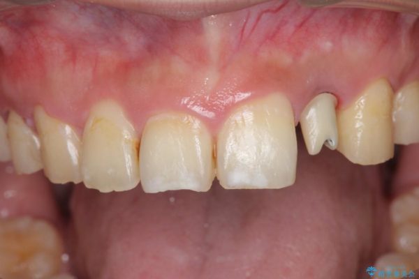 左上前歯のインプラント治療（セラミック治療編） 治療中画像
