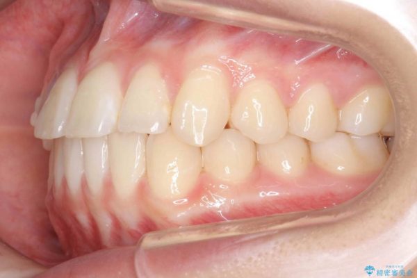 インビザラインで再矯正治療と右上前歯のセラミック治療 治療中画像
