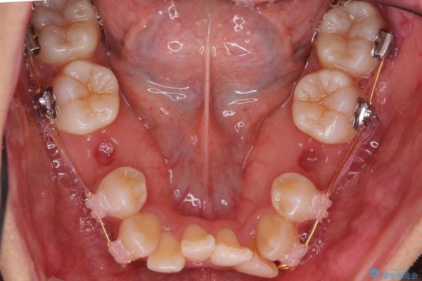 根の短い歯を抜歯 がたがたの歯並び矯正 治療中画像